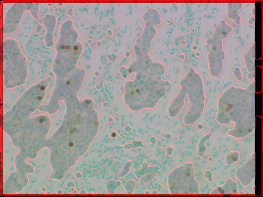 Image initiale superposée au contours des amas de cellules tumorales (lobules)